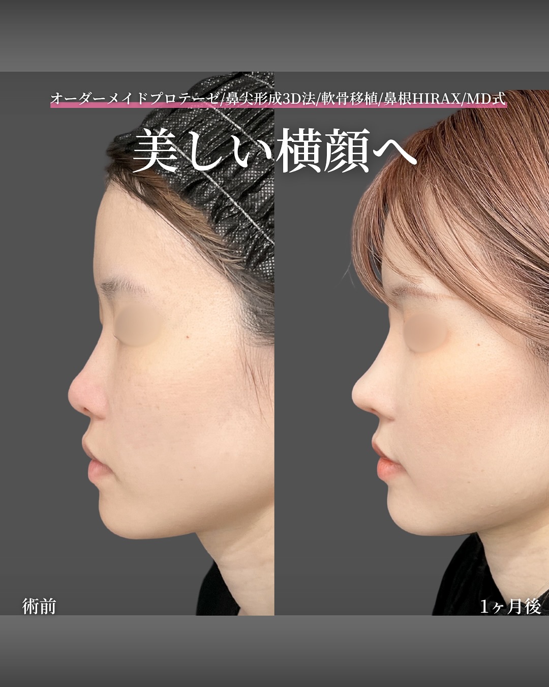 新宿院で行った鼻整形の名医の吉原伯医師のMD式のオーダーメイドプロテーゼと鼻尖形成3D法と軟骨移植と鼻根HIRAXの症例写真