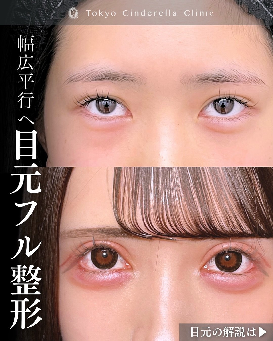 新宿院で行った二重整形で有名な吉原伯医師のMD式のたるみ取り併用全切開法二重術と眼瞼下垂手術と目頭切開と埋没法抜糸と他院修正の4ヶ月後の症例写真
