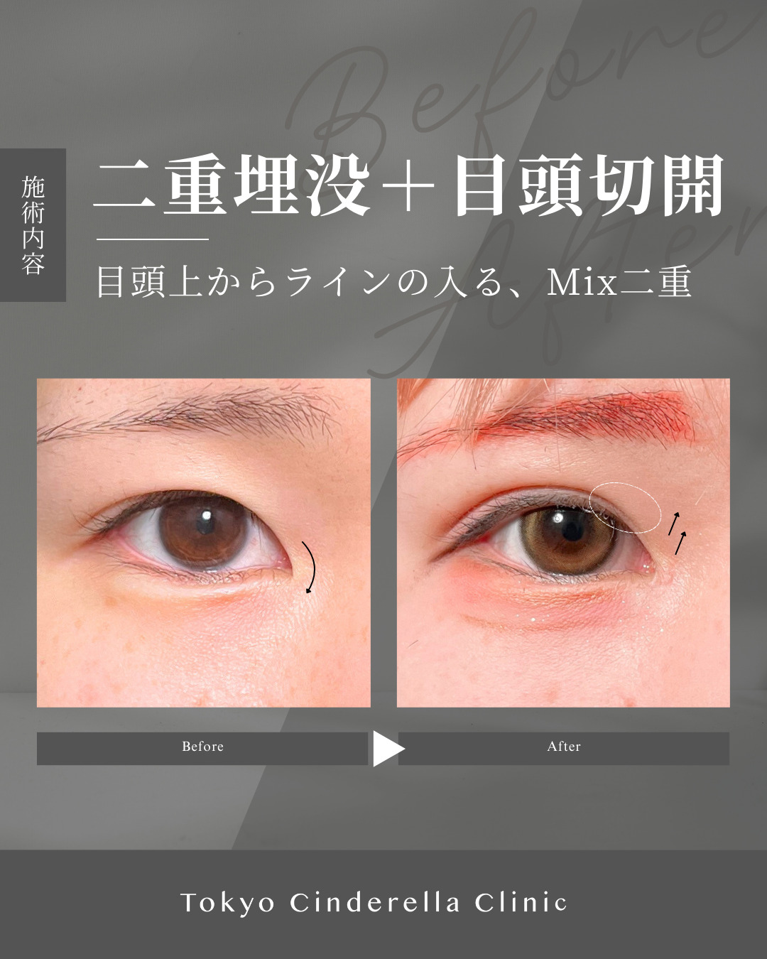 大宮院で行った二重整形で有名な竹田医師の二重埋没＋目頭切開の1ヶ月後の症例写真