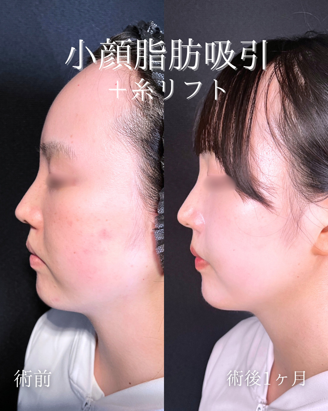 池袋院で行った小顔整形の石井達也医師の症例写真