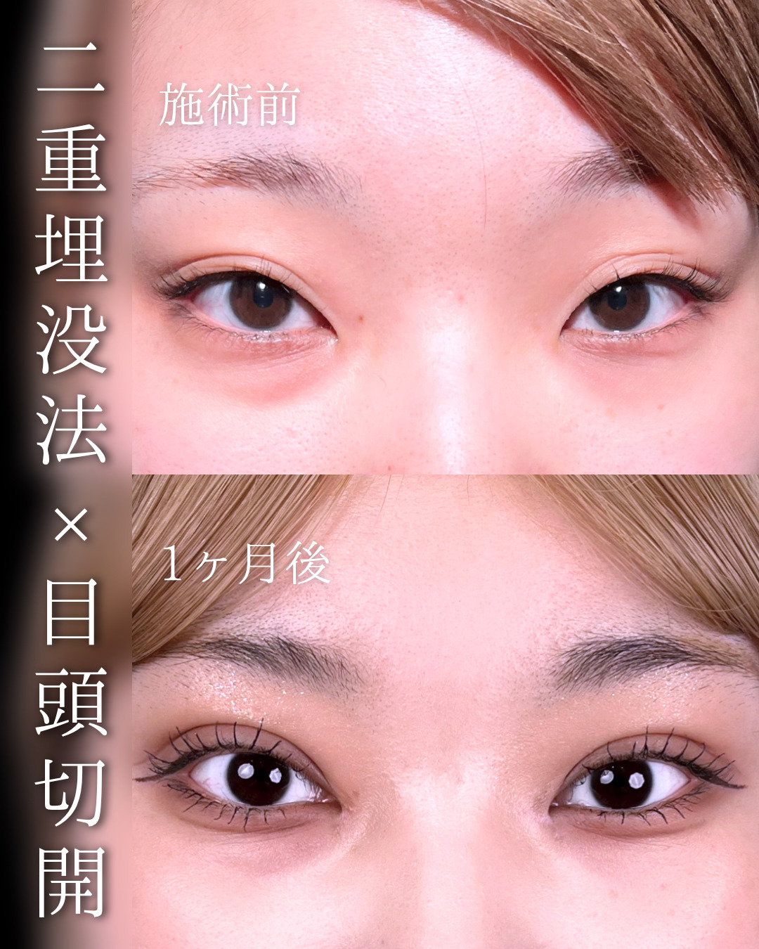 池袋院で行った二重整形と目頭切開の石井達也医師の症例写真