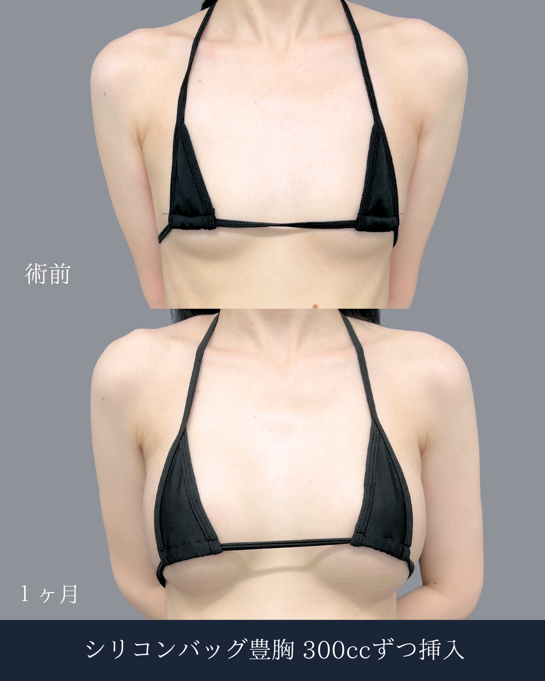 新宿院で行ったシリコンバッグ豊胸(セレフォーム)の名医の吉原伯医師の症例写真