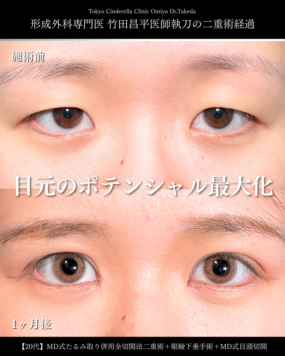 大宮院で行った二重整形の症例写真