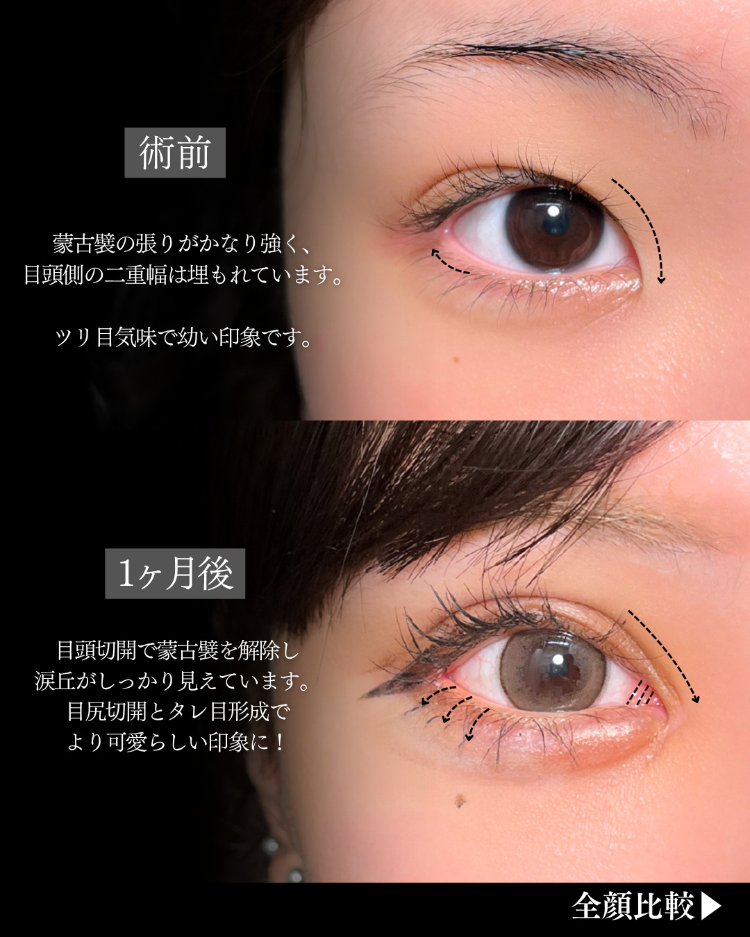 二重切開と眼瞼下垂と目頭切開と目尻切開と涙袋ヒアルで4方向拡大した１ヶ月の変化