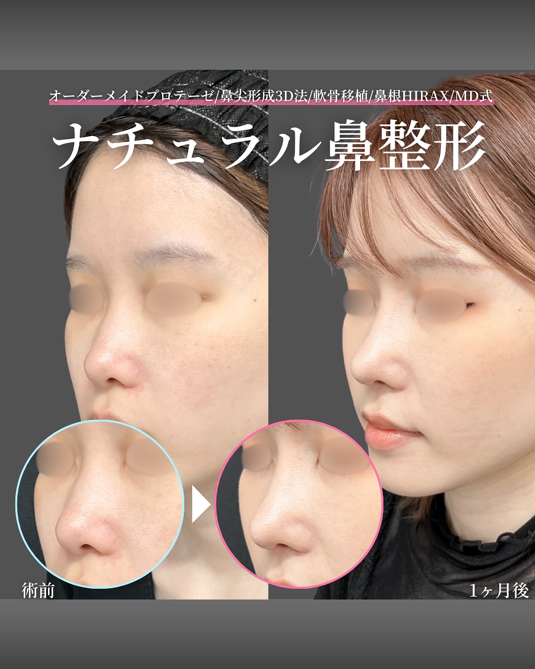 新宿院で行った鼻整形の名医の吉原伯医師のMD式のオーダーメイドプロテーゼと鼻尖形成3D法と軟骨移植と鼻根HIRAXの症例写真