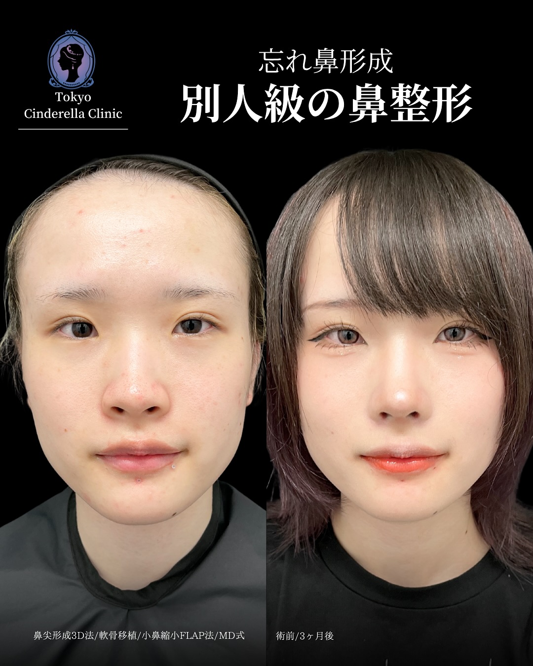 新宿院で行った鼻整形の名医の吉原伯医師のMD式の鼻尖形成3D法と軟骨移植と小鼻縮小FLAP法の症例写真