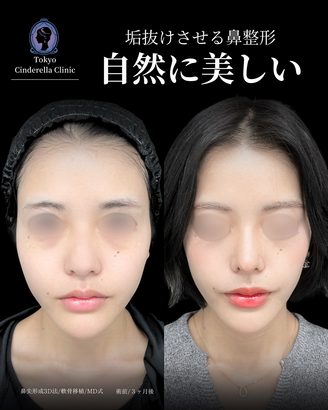 新宿院で行った鼻整形の名医の吉原伯医師のMD式の鼻尖形成3D法と軟骨移植の症例写真