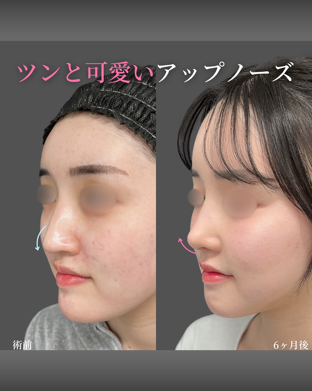 新宿院で行った鼻整形の名医の吉原伯医師のMD式の鼻尖形成3D法と軟骨移植とわし鼻切除と斜鼻修正と小鼻縮小FLAP法と猫手術の症例写真