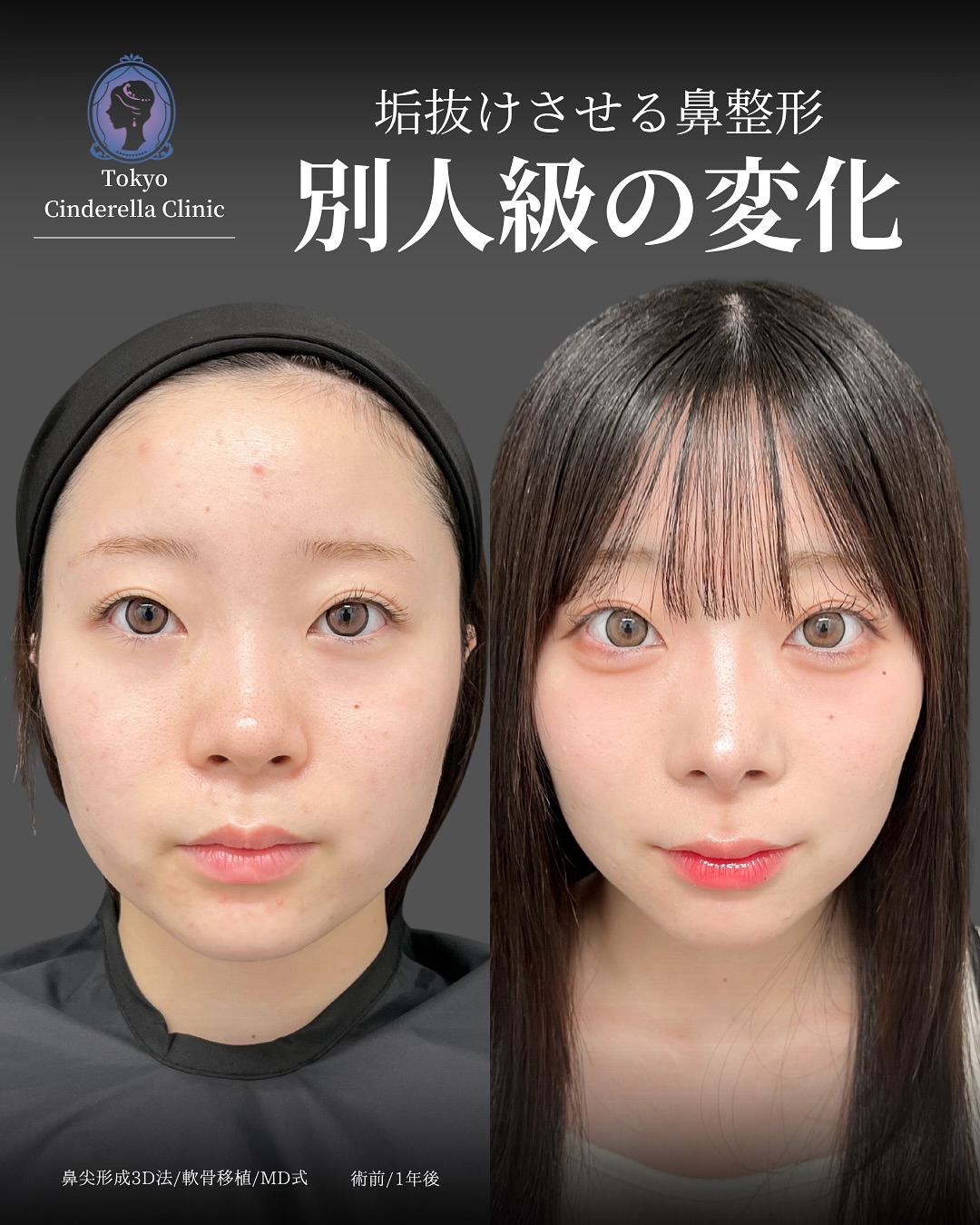 新宿院で行った鼻整形の名医の吉原伯医師のMD式の鼻尖形成3D法と軟骨移植の症例写真