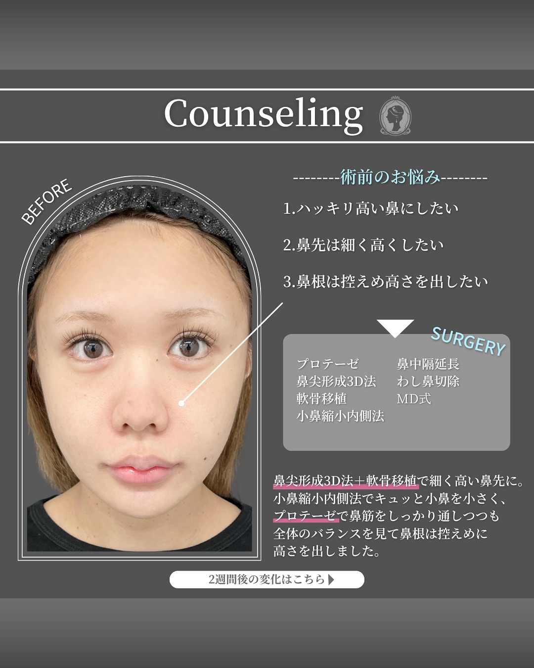 新宿院で行った鼻整形の名医の吉原伯医師のMD式のたるみ取り併用全切開法二重術と眼瞼下垂手術と埋没法抜糸の症例写真