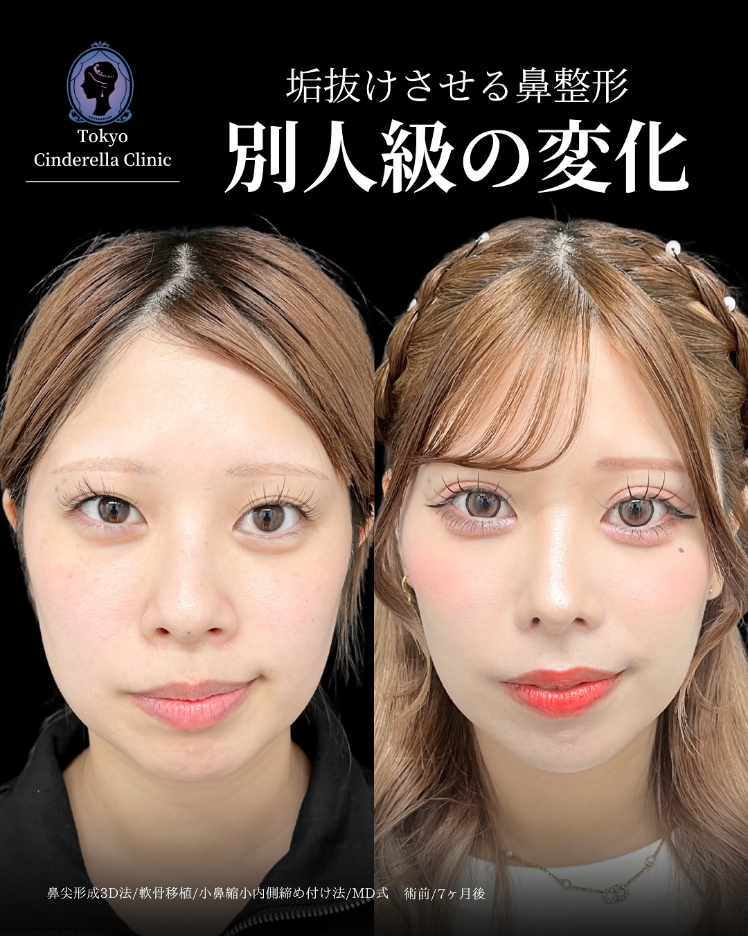 新宿院で行った鼻整形の名医の吉原伯医師のMD式の鼻尖形成3D法と軟骨移植と小鼻縮小内側締め付け法と韓国式自然癒着法6点の症例写真