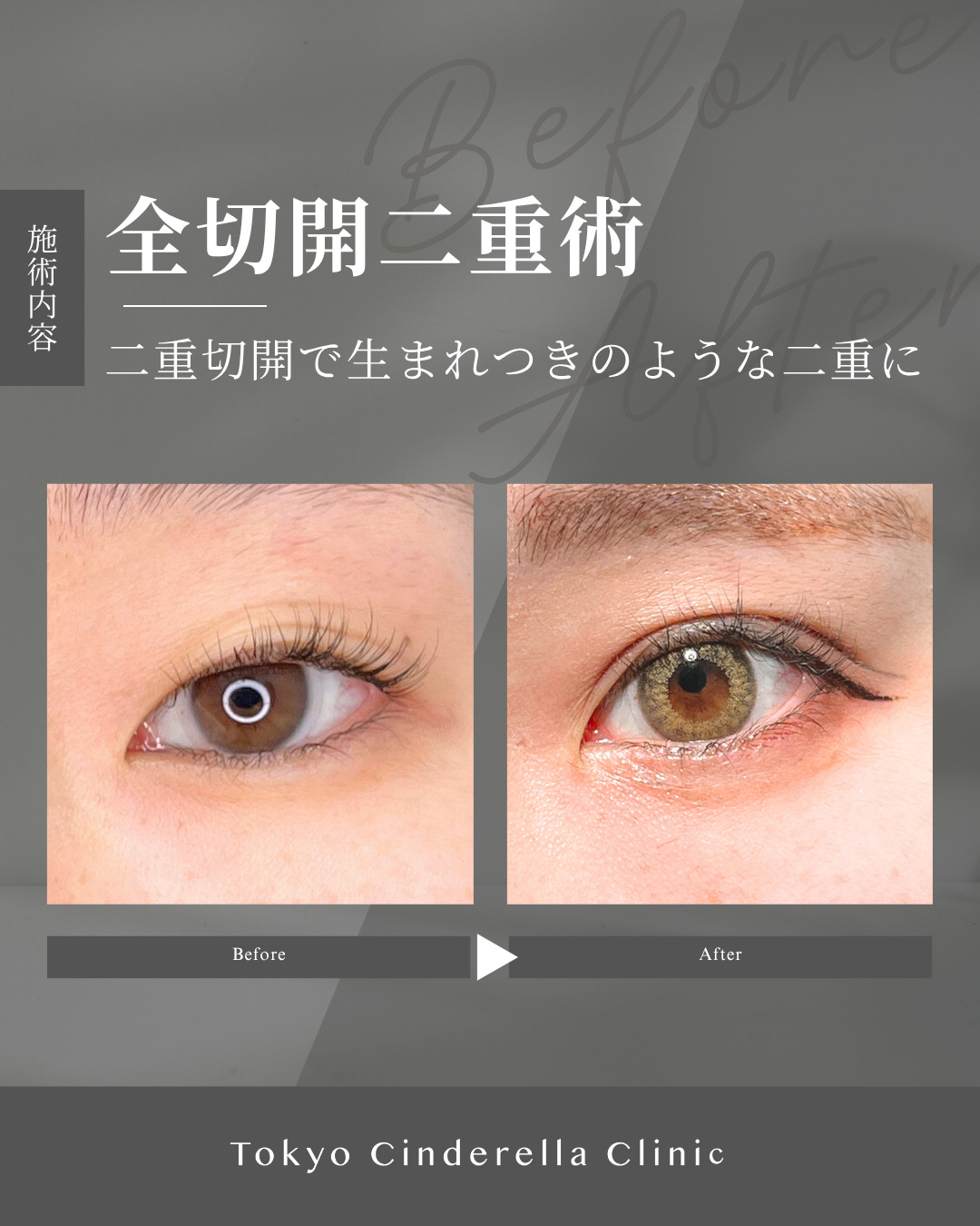 大宮院で行った二重整形の名医の竹田昌平医師のMD式全切開法二重術の症例写真