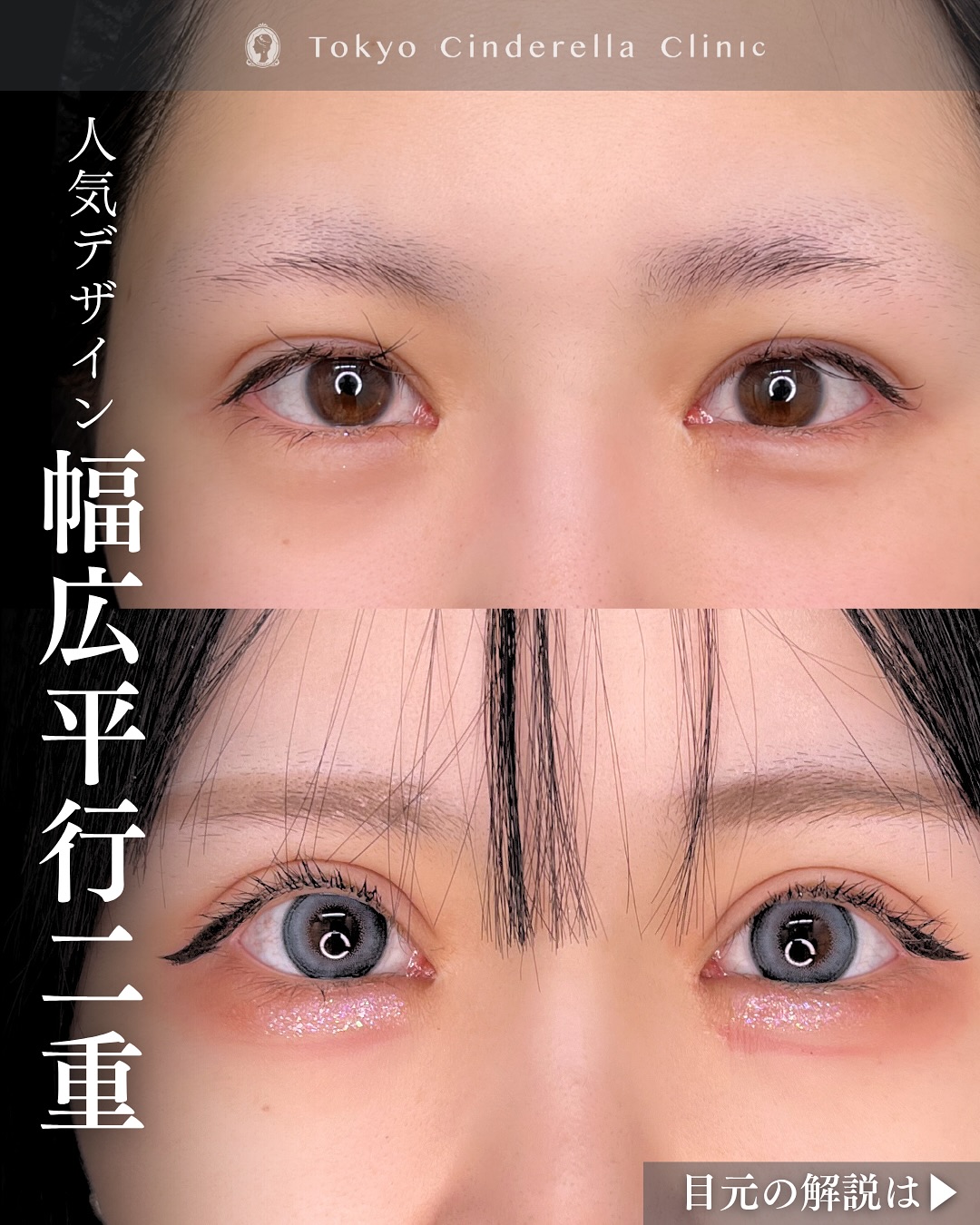 新宿院で行った二重整形で有名な吉原伯医師のMD式のたるみ取り併用全切開法二重術と眼瞼下垂手術と埋没法抜糸の6ヶ月後の症例写真