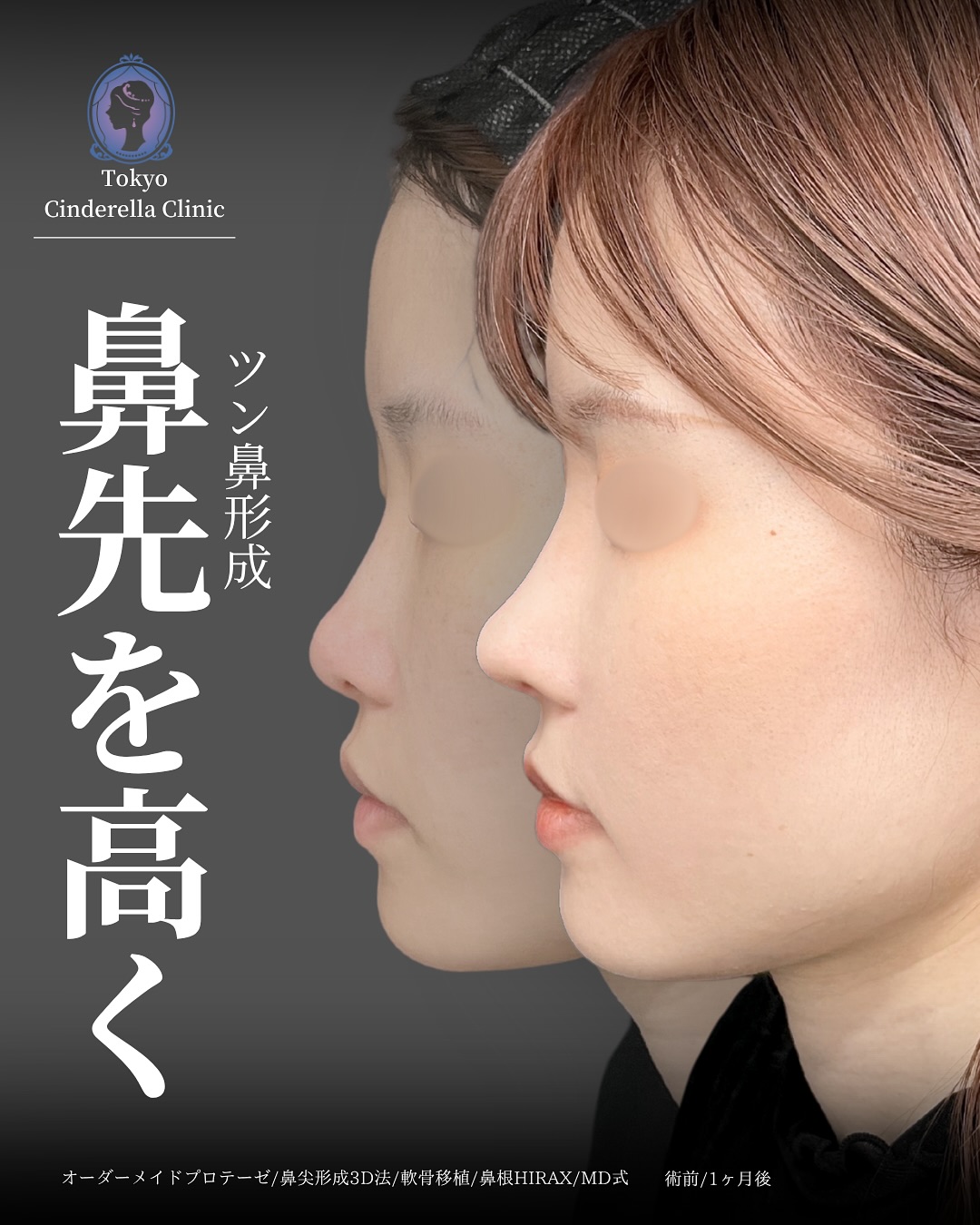 新宿院で行った鼻整形の名医の吉原伯医師のMD式のオーダーメイドプロテーゼと鼻尖形成3D法と軟骨移植と鼻根HIRAXの症例写真