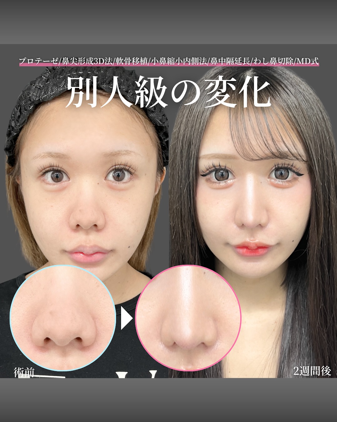 新宿院で行った鼻整形の名医の吉原伯医師のMD式のたるみ取り併用全切開法二重術と眼瞼下垂手術と埋没法抜糸の症例写真