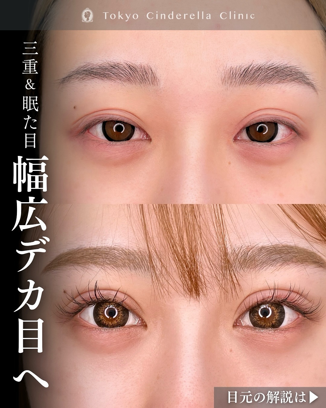 新宿院で行った二重整形で有名な吉原伯医師のMD式のたるみ取り併用全切開法二重術と眼瞼下垂手術と埋没法抜糸の1年後の症例写真