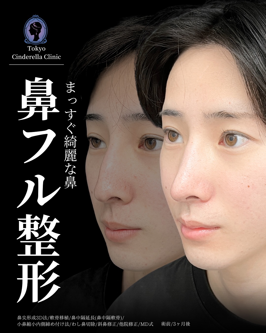 新宿院で行った鼻整形の名医の吉原伯医師のMD式の鼻尖形成3D法と軟骨移植と小鼻縮小内側締め付け法と鼻中隔延長(鼻中隔軟骨)とわし鼻切除と斜鼻修正の症例写真