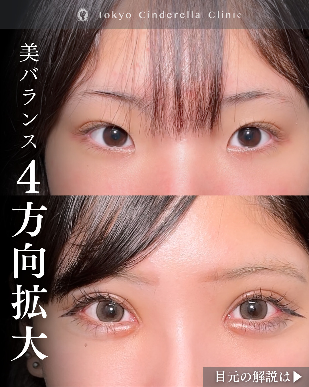 二重切開と眼瞼下垂と目頭切開と目尻切開と涙袋ヒアルで4方向拡大した１ヶ月の変化