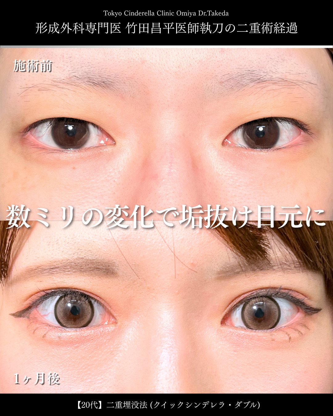 大宮院で行った二重整形の竹田医師の症例写真