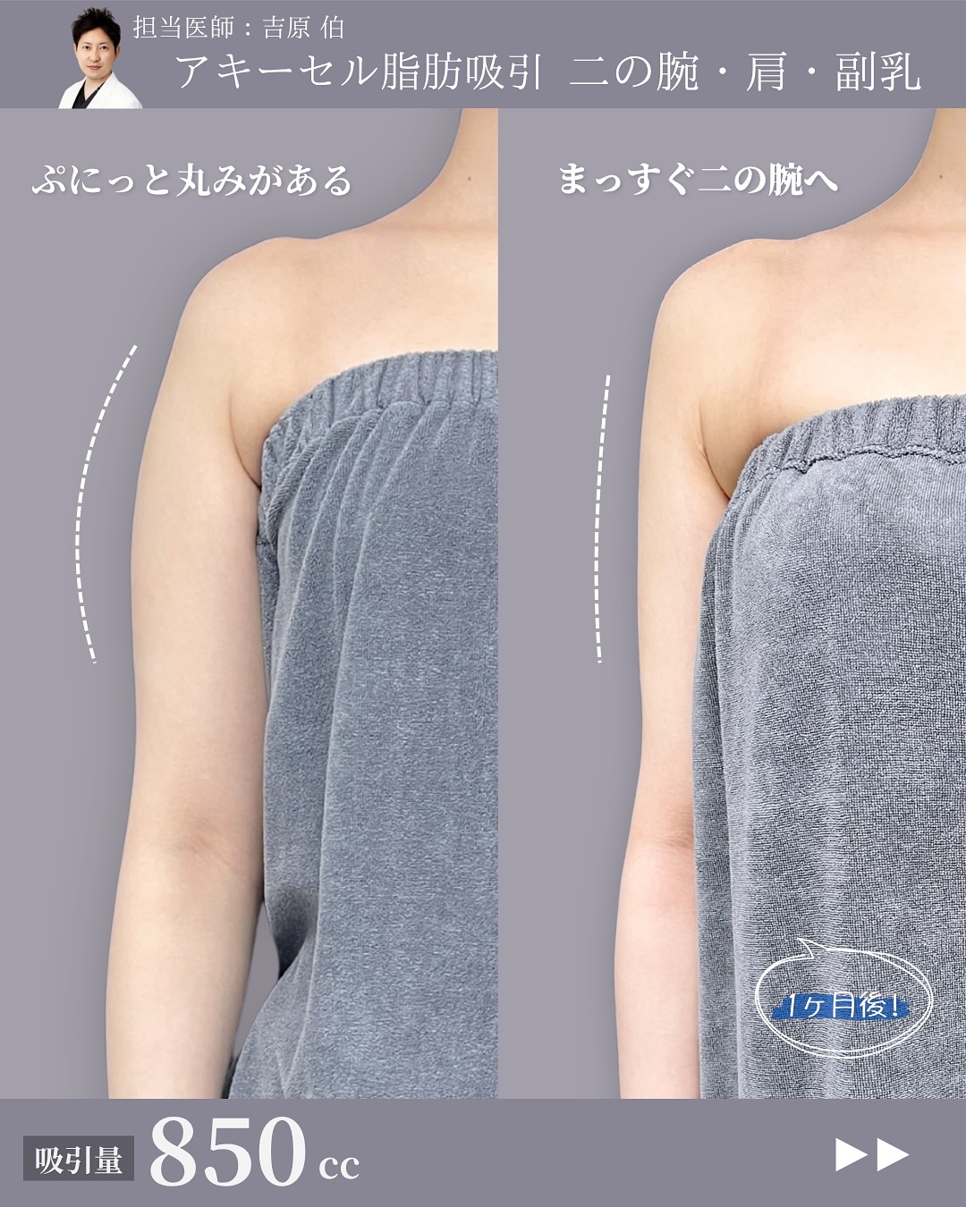 新宿院で行ったアキーセル脂肪吸引(二の腕・肩・副乳)の名医の吉原伯医師の症例写真
