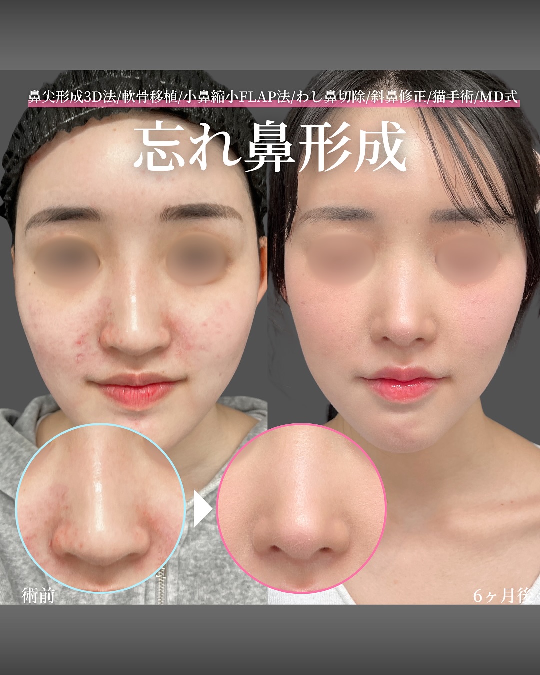新宿院で行った鼻整形の名医の吉原伯医師のMD式の鼻尖形成3D法と軟骨移植とわし鼻切除と斜鼻修正と小鼻縮小FLAP法と猫手術の症例写真