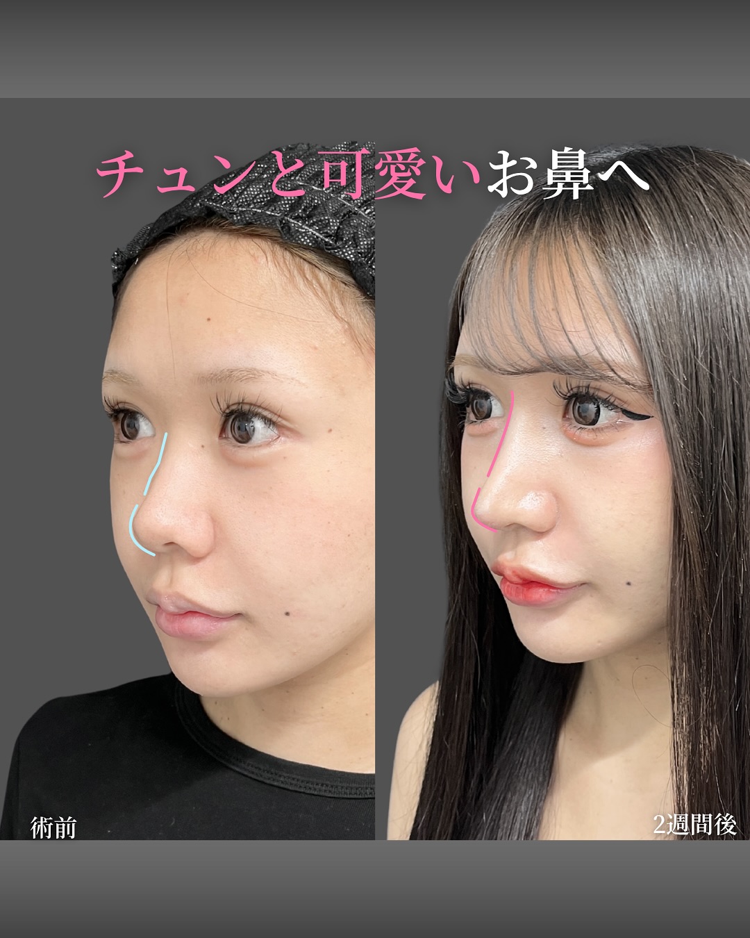 新宿院で行った鼻整形の名医の吉原伯医師のMD式のたるみ取り併用全切開法二重術と眼瞼下垂手術と埋没法抜糸の症例写真