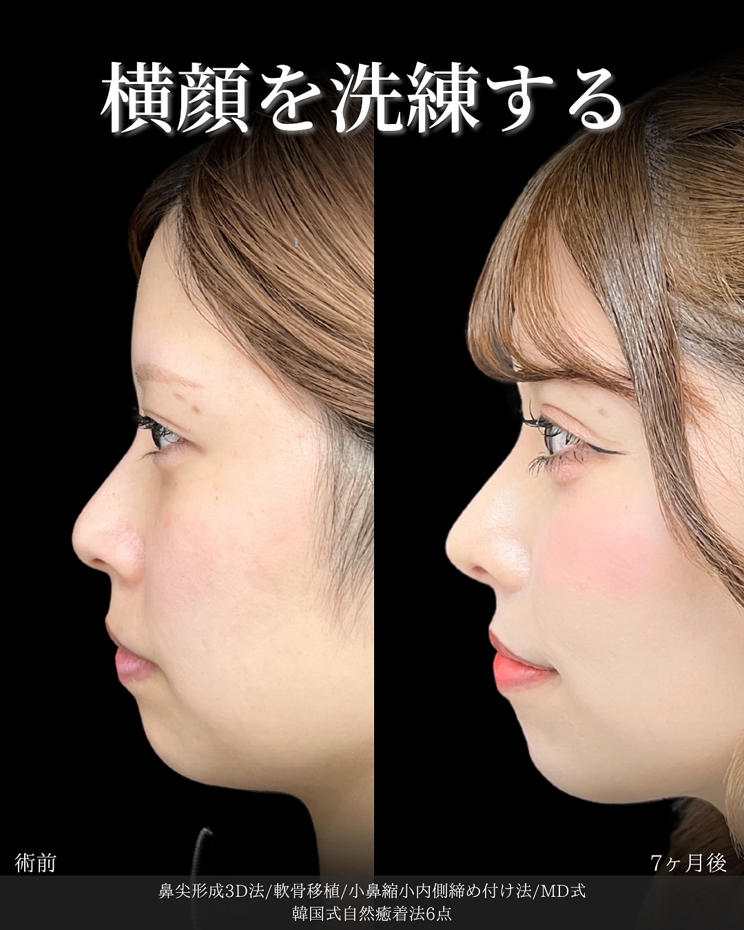 新宿院で行った鼻整形の名医の吉原伯医師のMD式の鼻尖形成3D法と軟骨移植と小鼻縮小内側締め付け法と韓国式自然癒着法6点の症例写真