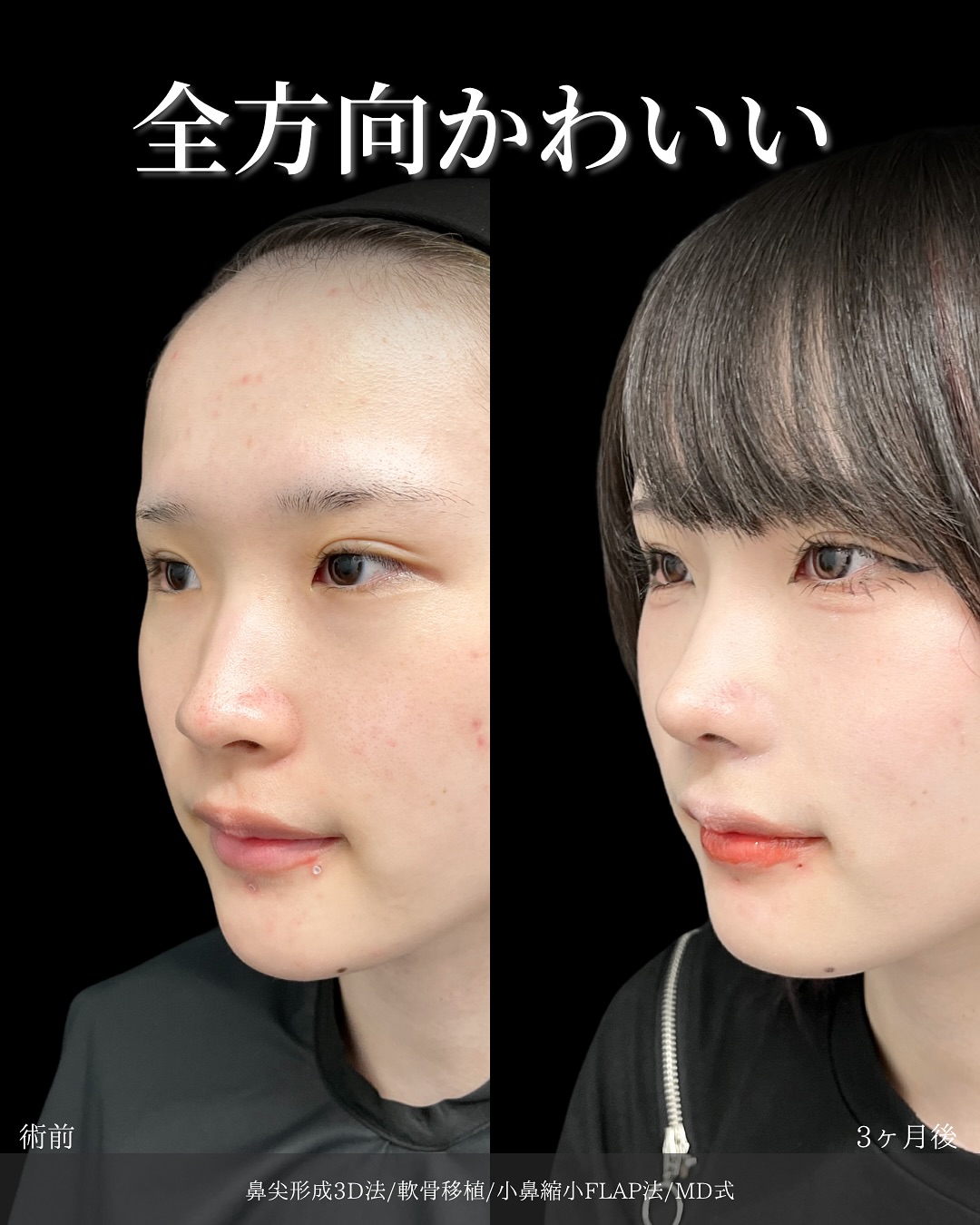 新宿院で行った鼻整形の名医の吉原伯医師のMD式の鼻尖形成3D法と軟骨移植と小鼻縮小FLAP法の症例写真
