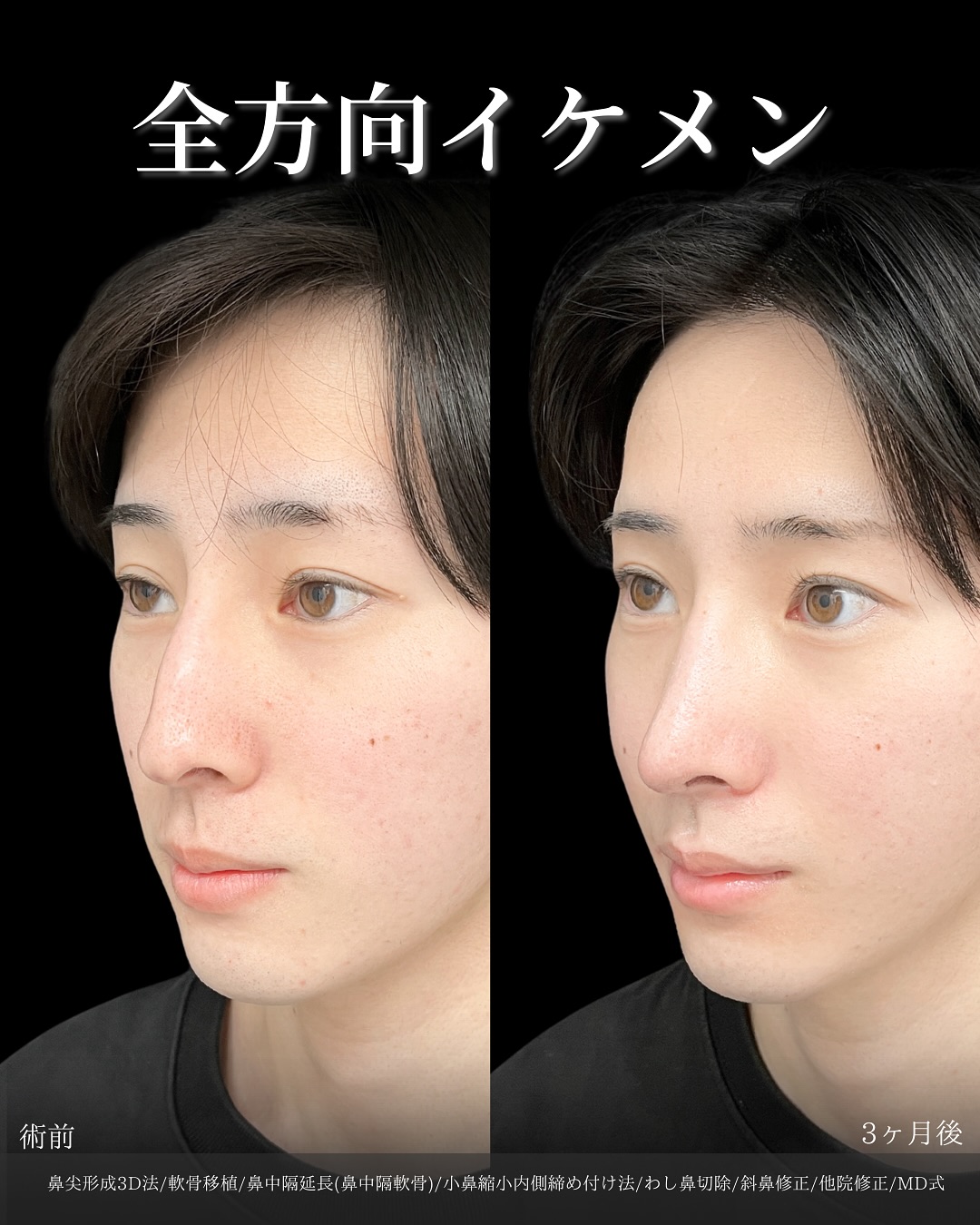新宿院で行った鼻整形の名医の吉原伯医師のMD式の鼻尖形成3D法と軟骨移植と小鼻縮小内側締め付け法と鼻中隔延長(鼻中隔軟骨)とわし鼻切除と斜鼻修正の症例写真
