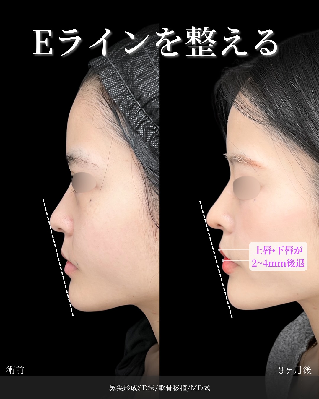 新宿院で行った鼻整形の名医の吉原伯医師のMD式の鼻尖形成3D法と軟骨移植の症例写真