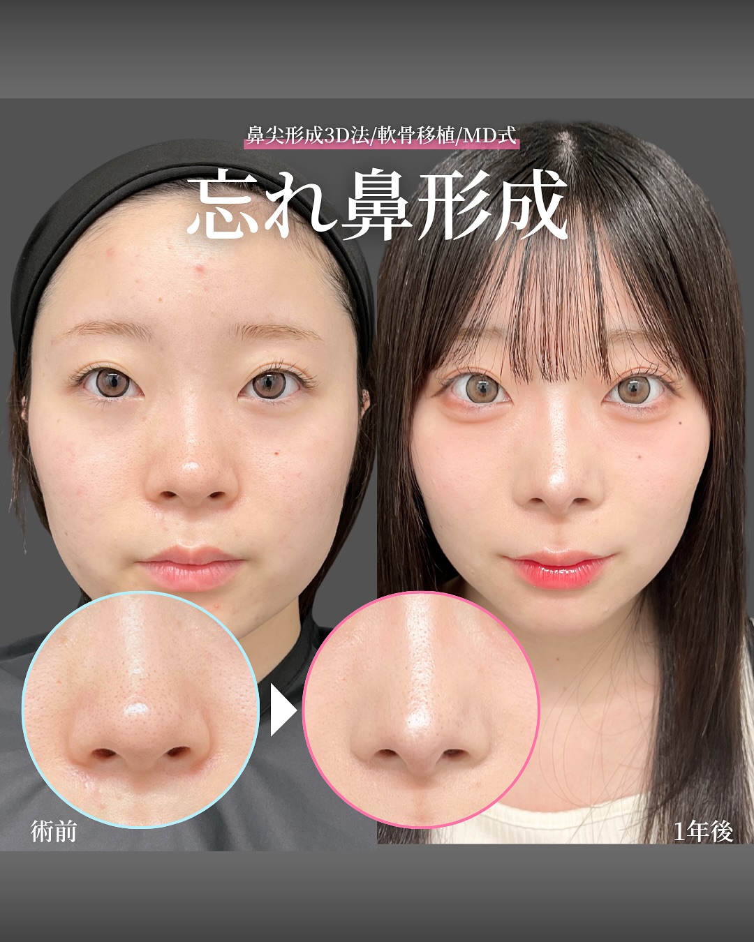 新宿院で行った鼻整形の名医の吉原伯医師のMD式の鼻尖形成3D法と軟骨移植の症例写真