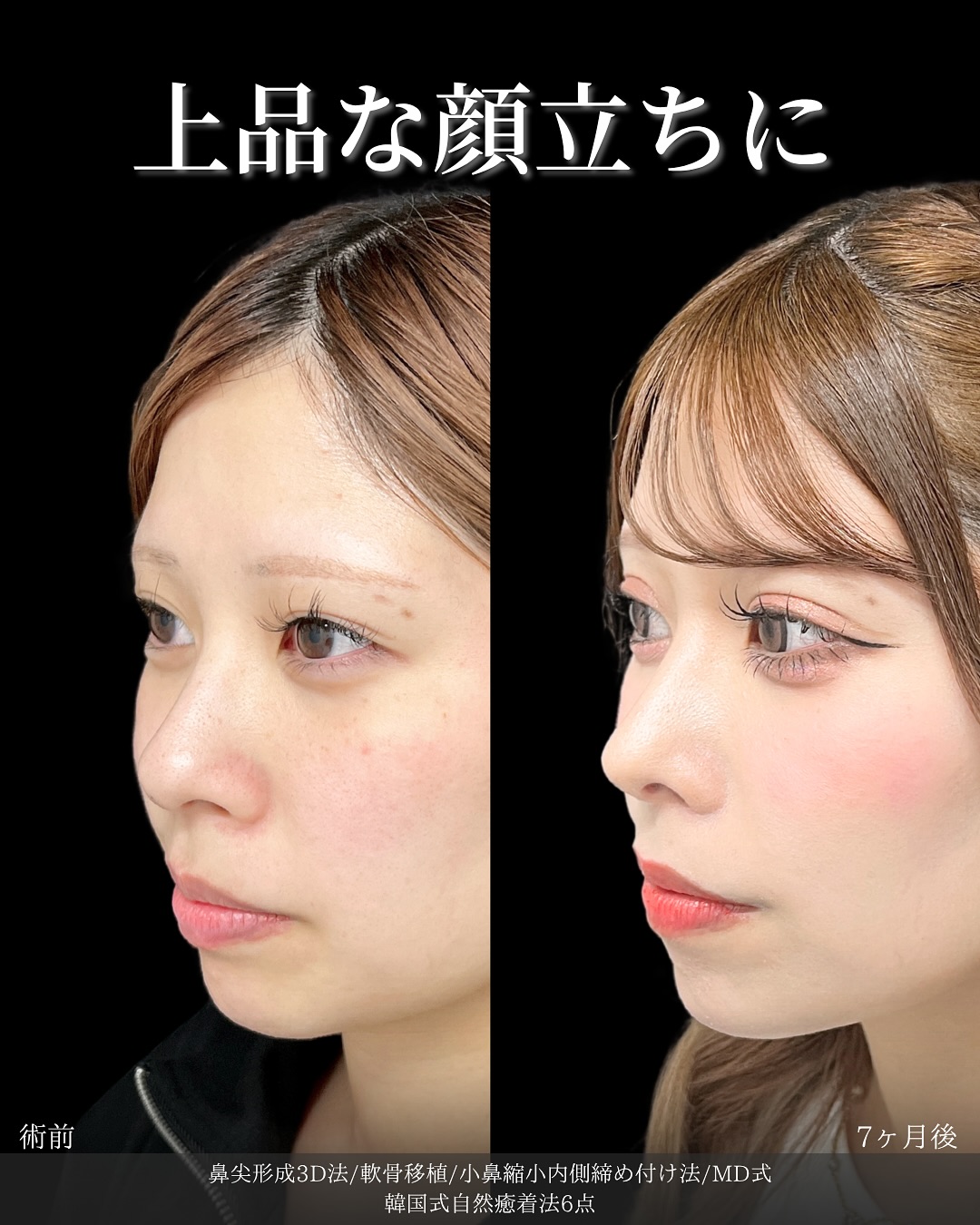 新宿院で行った鼻整形の名医の吉原伯医師のMD式の鼻尖形成3D法と軟骨移植と小鼻縮小内側締め付け法と韓国式自然癒着法6点の症例写真