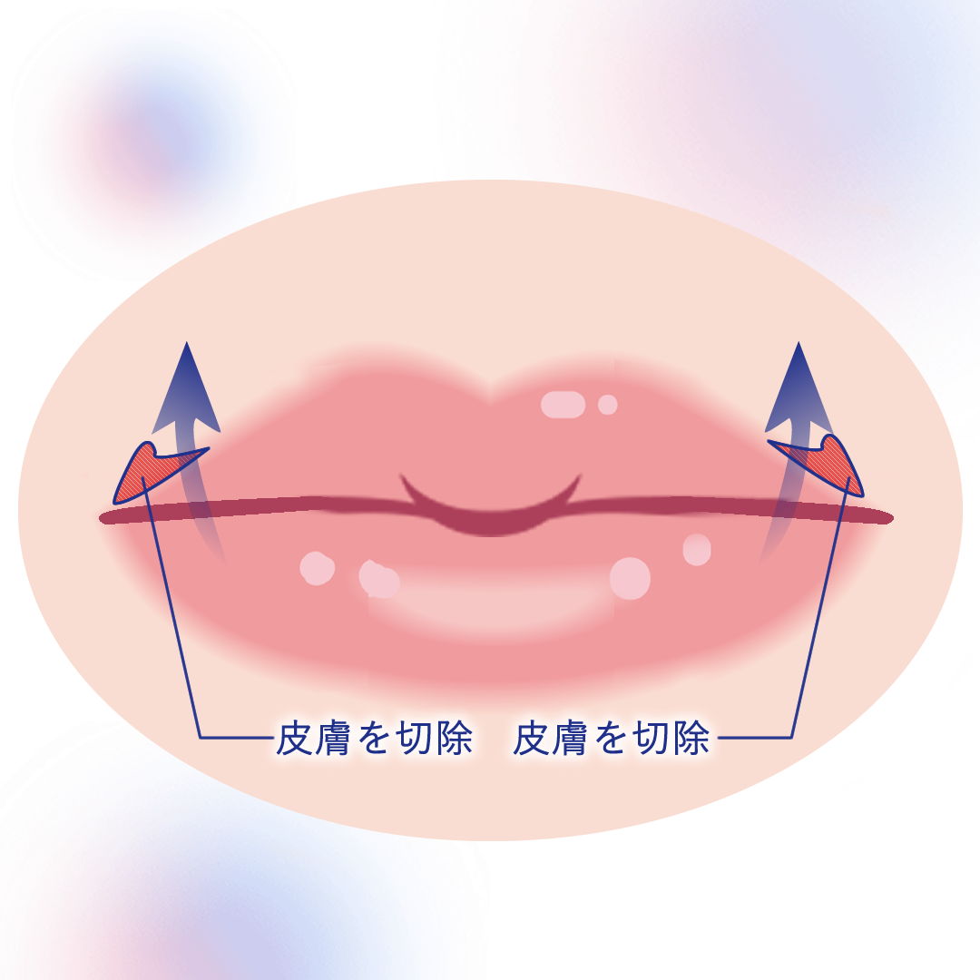 外側人中短縮の図解