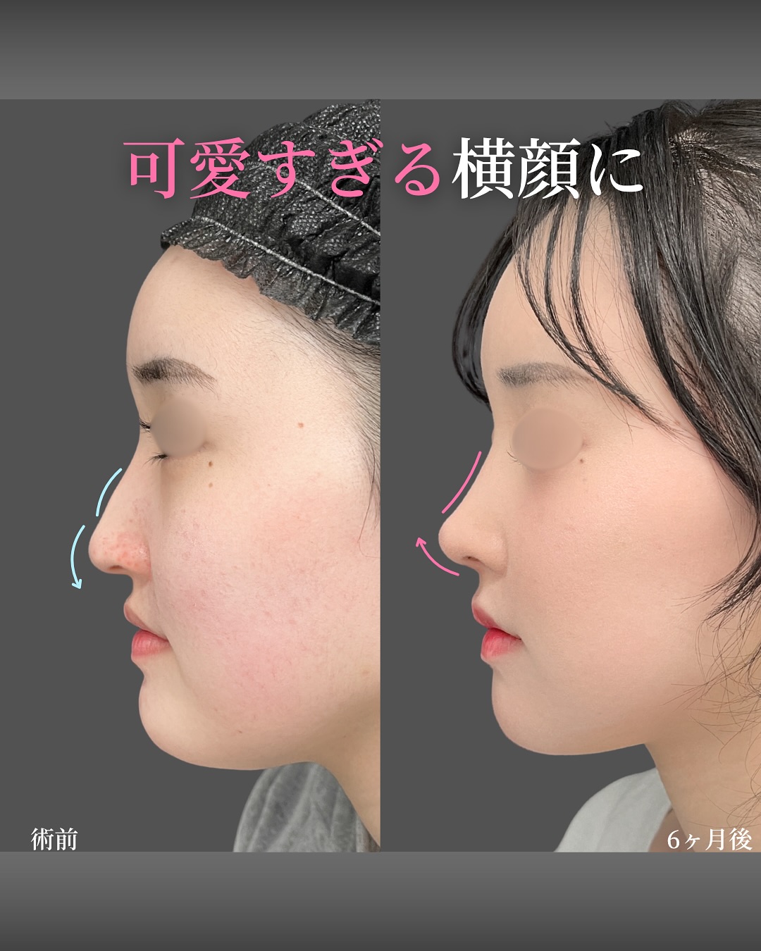 新宿院で行った鼻整形の名医の吉原伯医師のMD式の鼻尖形成3D法と軟骨移植とわし鼻切除と斜鼻修正と小鼻縮小FLAP法と猫手術の症例写真