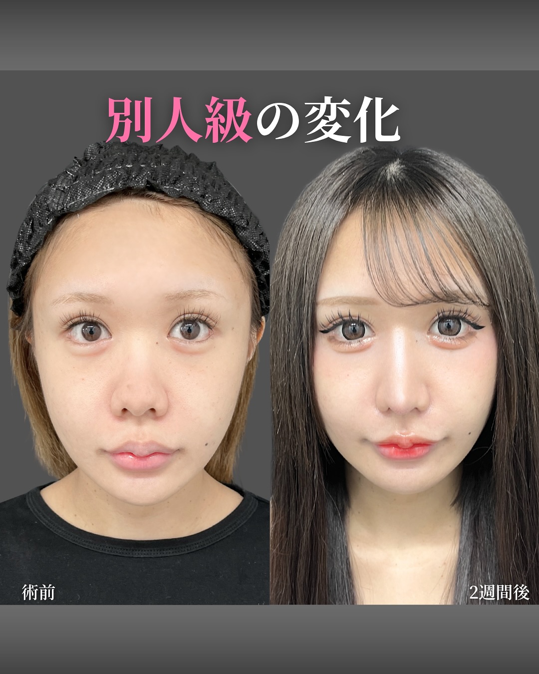 新宿院で行った鼻整形の名医の吉原伯医師のMD式のたるみ取り併用全切開法二重術と眼瞼下垂手術と埋没法抜糸の症例写真