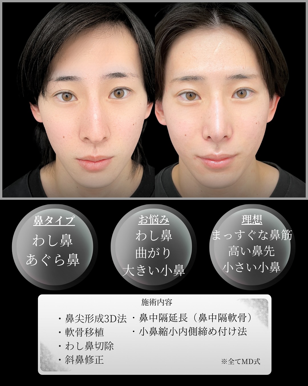 新宿院で行った鼻整形の名医の吉原伯医師のMD式の鼻尖形成3D法と軟骨移植と小鼻縮小内側締め付け法と鼻中隔延長(鼻中隔軟骨)とわし鼻切除と斜鼻修正の症例写真
