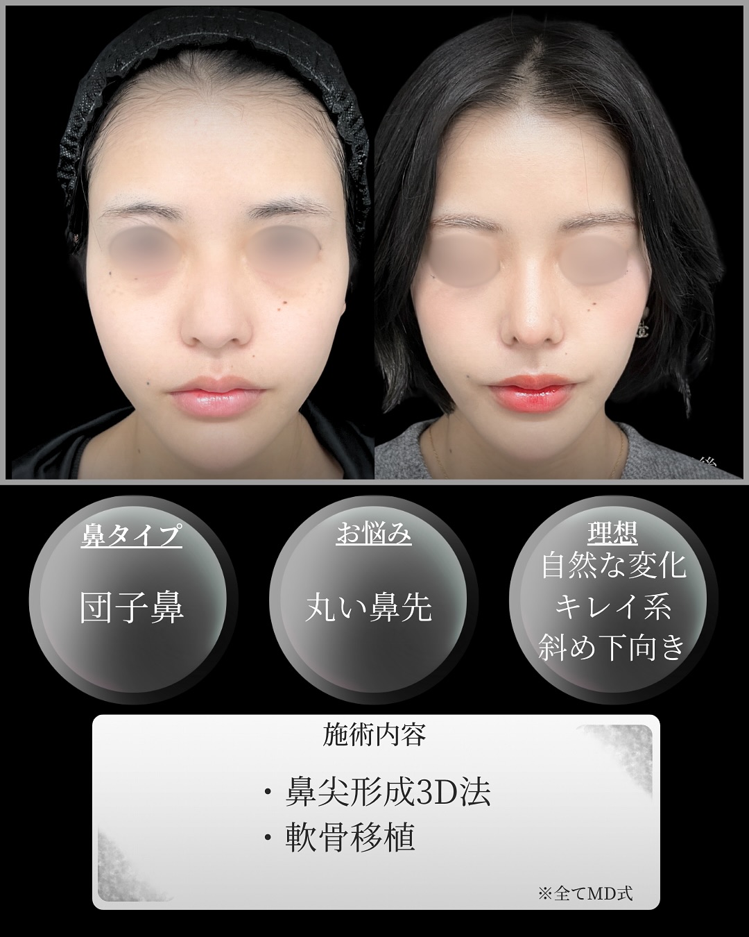 新宿院で行った鼻整形の名医の吉原伯医師のMD式の鼻尖形成3D法と軟骨移植の症例写真