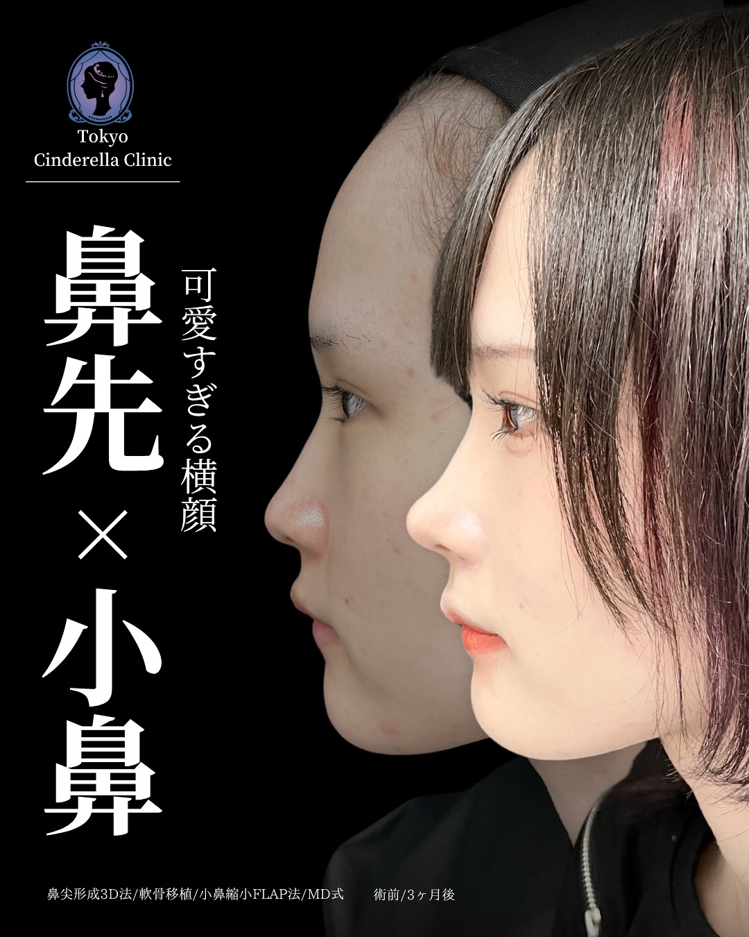 新宿院で行った鼻整形の名医の吉原伯医師のMD式の鼻尖形成3D法と軟骨移植と小鼻縮小FLAP法の症例写真