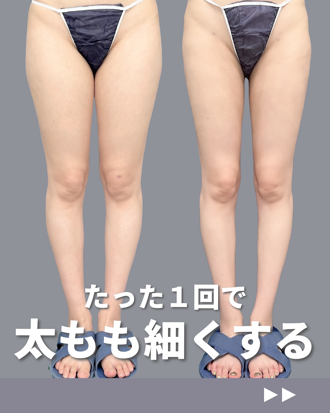 新宿院で行ったアキーセル脂肪吸引(太もも全周・お尻・膝)の名医の吉原伯医師の症例写真