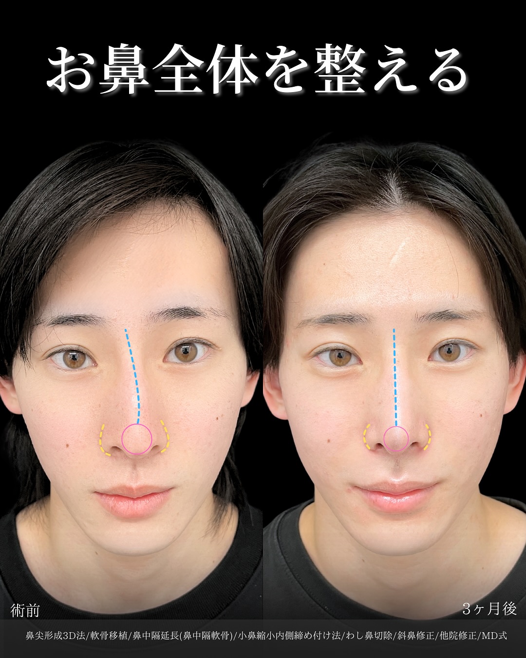 新宿院で行った鼻整形の名医の吉原伯医師のMD式の鼻尖形成3D法と軟骨移植と小鼻縮小内側締め付け法と鼻中隔延長(鼻中隔軟骨)とわし鼻切除と斜鼻修正の症例写真