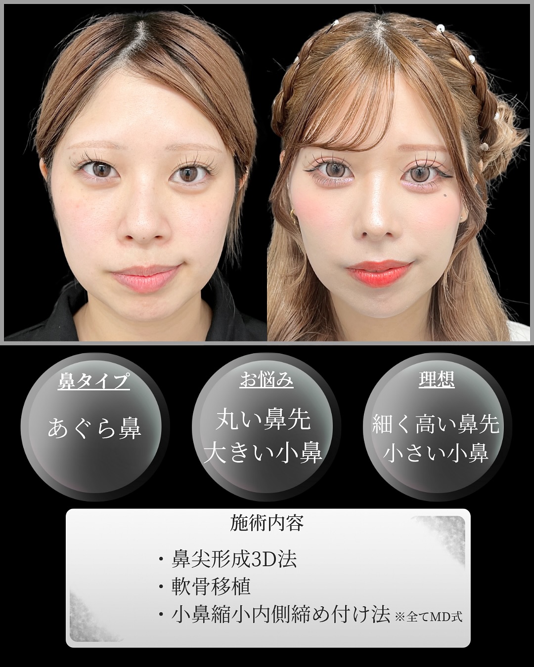 新宿院で行った鼻整形の名医の吉原伯医師のMD式の鼻尖形成3D法と軟骨移植と小鼻縮小内側締め付け法と韓国式自然癒着法6点の症例写真