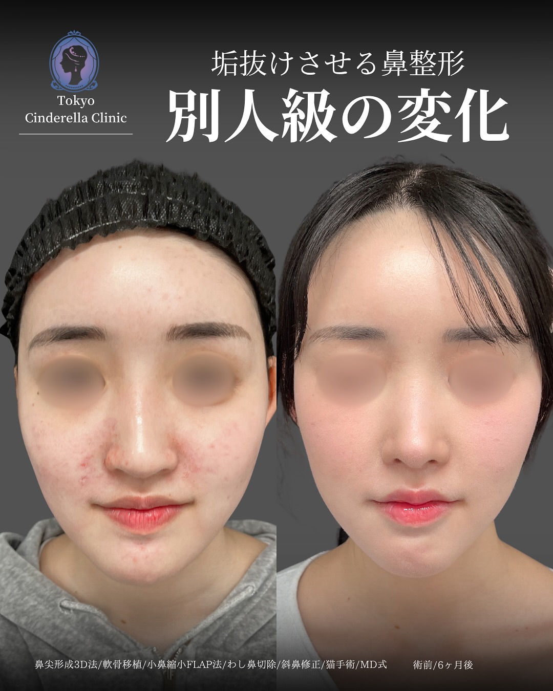 新宿院で行った鼻整形の名医の吉原伯医師のMD式の鼻尖形成3D法と軟骨移植とわし鼻切除と斜鼻修正と小鼻縮小FLAP法と猫手術の症例写真