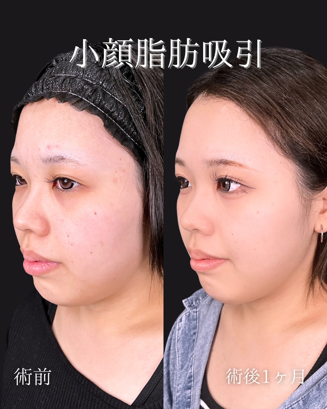 小顔脂肪吸引でスッキリとした輪郭に
