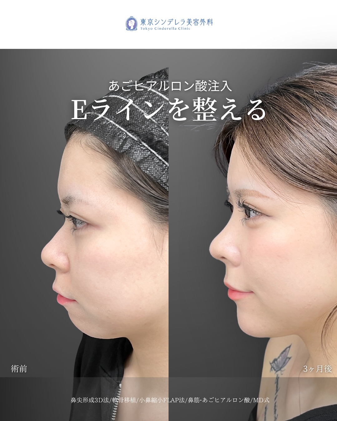 新宿院で行った鼻整形の名医の吉原伯医師のMD式の鼻尖形成3D法と軟骨移植と小鼻縮小FLAP法とあごヒアルロン酸の症例写真