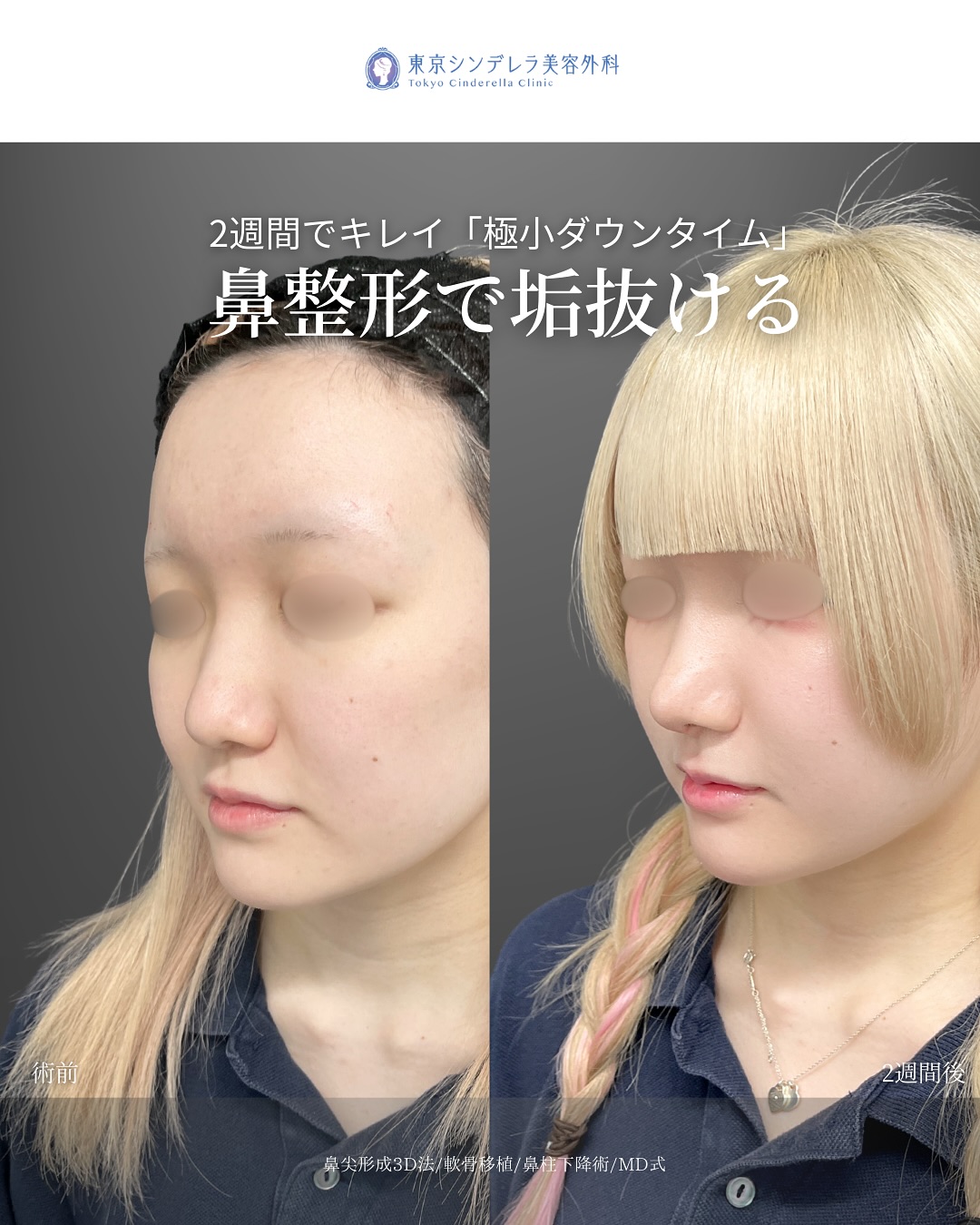 新宿院で行った鼻整形の名医の吉原伯医師のMD式の鼻尖形成3D法と軟骨移植と鼻柱下降術の症例写真