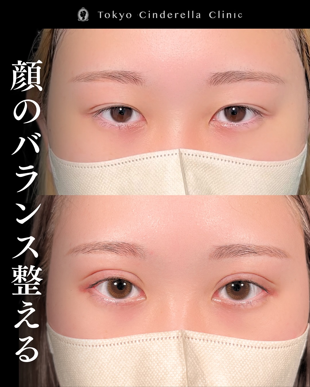 新宿院で行った二重整形の名医の吉原伯医師のMD式のたるみ取り併用全切開法二重術と眼瞼下垂手術と目尻切開の症例写真