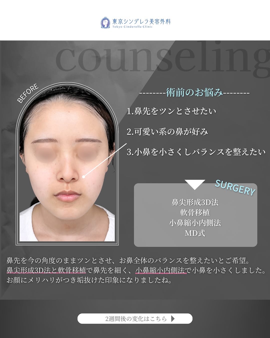 新宿院で行った鼻整形の名医の吉原伯医師のMD式の鼻尖形成3D法と軟骨移植と小鼻縮小内側法の症例写真