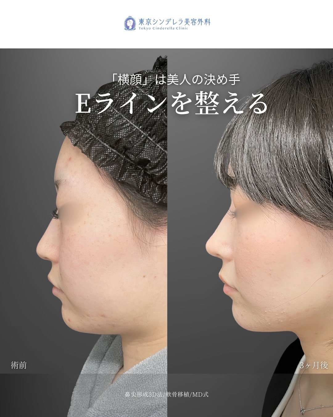 新宿院で行った鼻整形の名医の吉原伯医師のMD式の鼻尖形成3D法と軟骨移植の症例写真