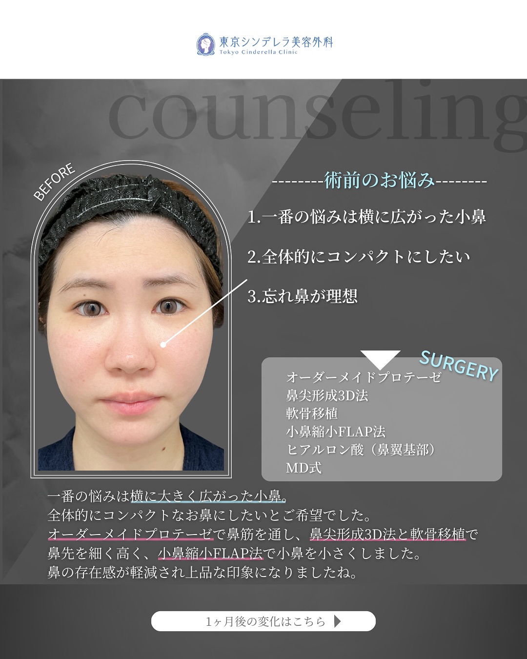 新宿院で行った二重整形の名医の吉原伯医師のMD式の鼻尖形成3D法と軟骨移植と小鼻縮小FLAP法とヒアルロン酸(鼻翼基部)と二重埋没法と目頭切開の症例写真