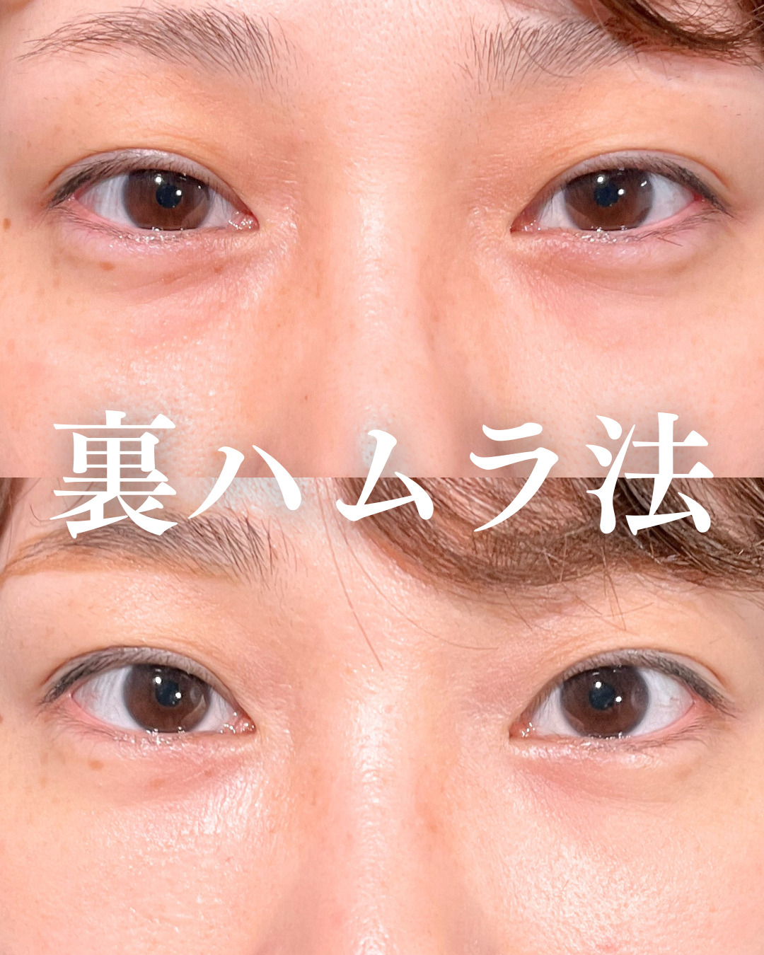 大宮院で行ったMD式の裏ハムラ法の名医の竹田昌平医師の症例写真